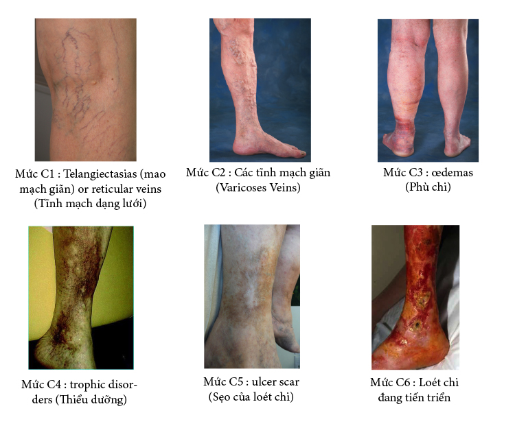 Các ảnh hưởng nguy hiểm của bệnh giãn tĩnh mạch chân
