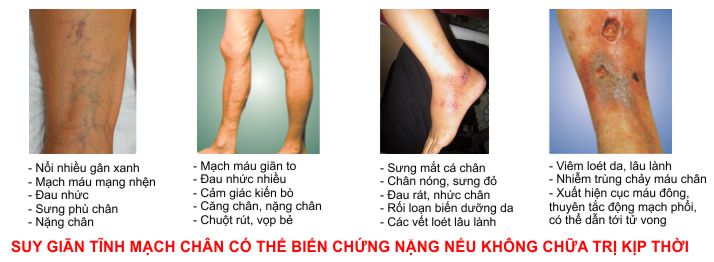 Biến chứng nguy hiểm của bệnh giãn tĩnh mạch chân